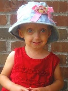 Rarología: Progeria