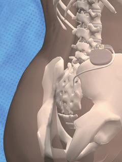 InterStim® II La imagen se encuentra en el servidor de Medgadget