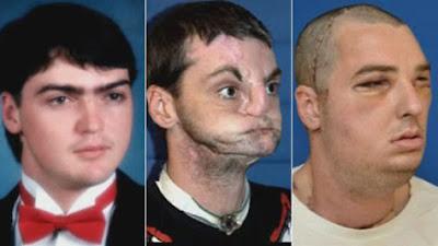 EEUU realiza el trasplante de cara más completo del mundo
