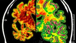 (399) SER BILINGÜE PROTEGE AL CEREBRO DE LA DEMENCIA (399) SER BILINGÜE PROTEGE AL CEREBRO DE LA DEMENCIA