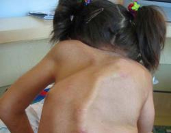 En que se basa la Fibrodisplasia osificante Blog de Farmacia En que se basa la Fibrodisplasia osificante