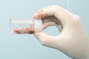 cordon umbilical - USP Hospitales - flickr Células madre del cordón umbilical