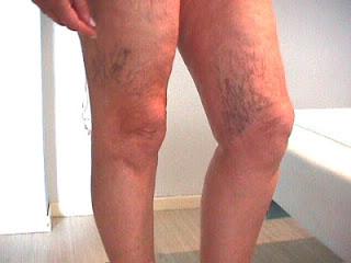 ¿Se pueden prevenir las varices? ¿Se pueden prevenir las varices?