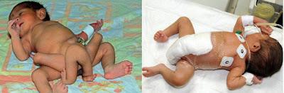 Operan con éxito a bebé seis piernas