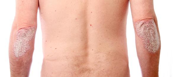 Del niño al mar con atopicheskim por la dermatitis