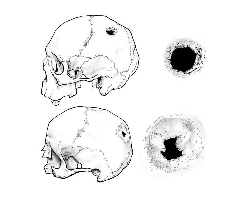 Encuentran en Soria dos cráneos trepanados de la Edad Media Encuentran en Soria dos cráneos trepanados de la Edad Media