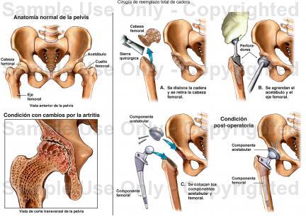 SaludPuede hacerse para reparar o reemplazar los huesos d... SaludPuede hacerse para reparar o reemplazar los huesos d...