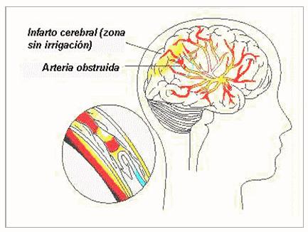 infarto cerebral Mayor riesgo de padecer infarto cerebral por fibrilación auricular durante hospitalización