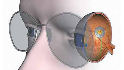Implante fotovoltáico en la retina para curar algunos tipos de ceguera