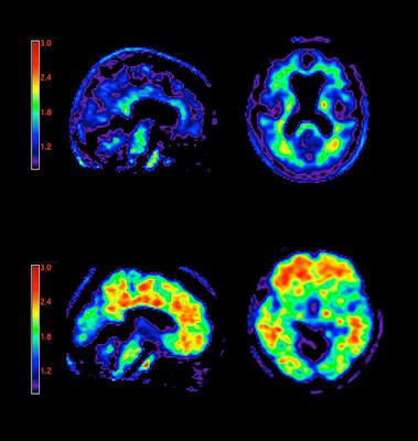 Análisis de placas: En un escáner PET, un medio de contraste muestra la acumulación de placas amiloides en un paciente de alzhéimer (panel inferior) en comparación con un paciente cognitivamente normal (panel superior). El extremo rojo de la escala de colores muestra la unión máxima del medio de contraste y el extremo negro/azul muestra la unión mínima.  Fuente: Avid Radiopharmaceuticals