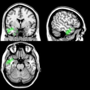 mri_pic_hsieh Las partes responsables del reconocimiento lingüístico también lo son de las emociones