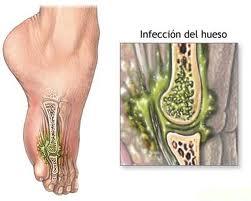 Las infecciones óseas pueden ser tratadas