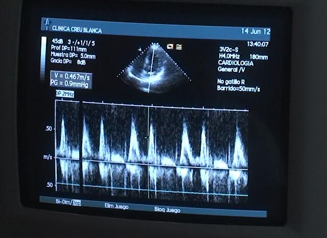 Resultado de la prueba de esfuerzo y el estudio ecocardiográfico, Doppler, espectral y color previo al Isostar Desert Marathon Resultado de la prueba de esfuerzo y el estudio ecocardiográfico, Doppler, espectral y color previo al Isostar Desert Marathon