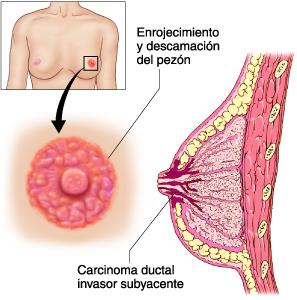 Un tipo de cáncer de mama poco común