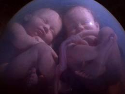 El parto en el embarazo múltiple El parto en el embarazo múltiple