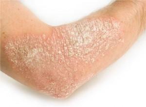 Una enfermedad de la piel muy molesta y costosa: La Psoriasis