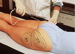 La grasa vuelve a aparecer luego de una liposucción La grasa vuelve a aparecer luego de una liposucción