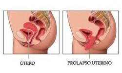 prolapso Un segundo procedimiento podría cortar el riesgo de incontinencia tras cirugía por prolapso de órganos