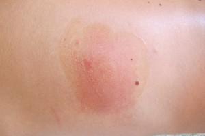 Hidra Gel en una picadura de avispa Cuidados de la piel durante el verano