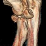 Fractura conminuta de cabeza radial PRÓTESIS DE CABEZA DE RADIO