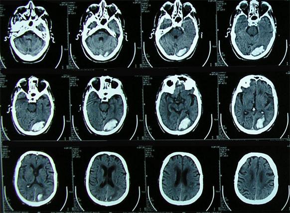 Tomografia Axial Computarizada TAC Los instrumentos de investigación más utilizados en Neuropsicología