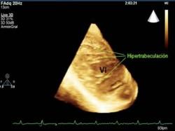 hiper-trabeculación de ventrículo izquierdo Una nueva anormalidad en el “corazón de atleta”
