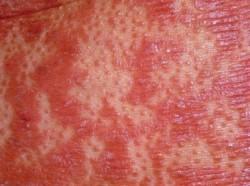 gen CARD14 Identifican gen detrás de la psoriasis