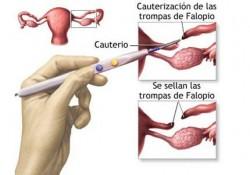 ligadura-de-trompas ¿En que consiste la ligadura de trompas?