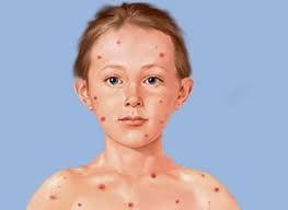 La varicela, una enfermedad leve para los niños y a veces complicada para los adultos