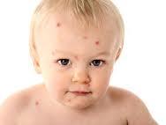 La varicela, una enfermedad leve para los niños y a veces complicada para los adultos