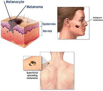 cancer_melanoma Los sobrevivientes del cáncer tienen un riesgo mayor de desarrollar melanoma