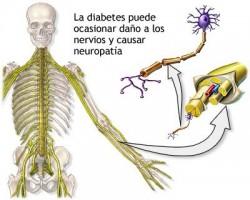 Polineuropatía diabética: alivio natural del dolor