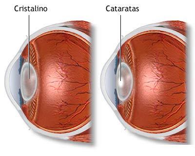 Cataratas y Baja Visión