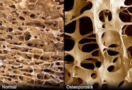 a1145 Osteoporosis, menopausia, calcio, vitaminas y carótenos  