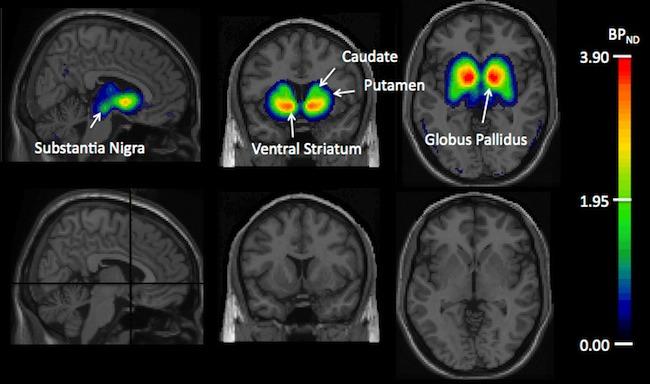GSK598809 Un nuevo medicamento en fase de desarrollo disminuye la adicción a la nicotina