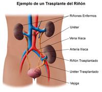 Preguntas y respuestas del Trasplante Renal