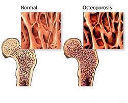 ¿Qué es la osteoporosis? ¿Qué es la osteoporosis?