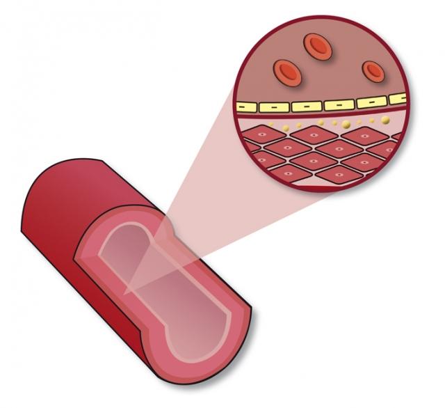 infografia-pared-vascular-colesterol-ldl pared-vascular-colesterol-ldl