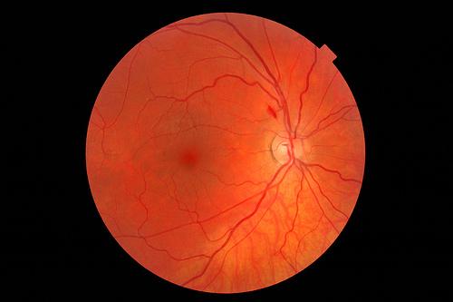Detectar alzheimer en los ojos Detectar alzheimer en los ojos