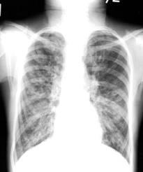 fibrosis pulmonar idiopatica Estamos en la semana de la Fibrosis Pulmonar Idiopática