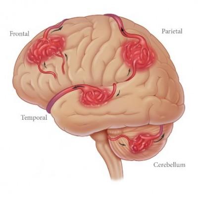 Las hemorragias cerebrales son más comunes en fumadores Las hemorragias cerebrales son más comunes en fumadores