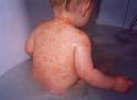 Los expertos ofrecen directrices para una mejor prevención del ezcema en los niños Los expertos ofrecen directrices para una mejor prevención del ezcema en los niños