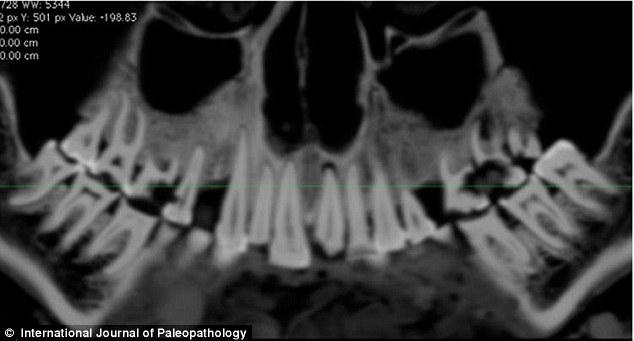 Encuentran momia egipcia de 2.100 años de antigüedad con empastes en los dientes.