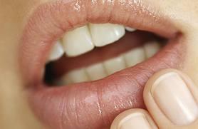 ¿Queréis prevenir los Herpes labiales? Probad esta receta!
