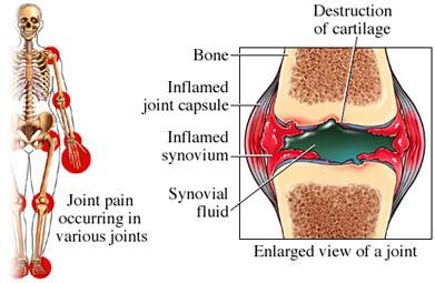 La artritis reumatoide: su foco de ataque a las articulaciones