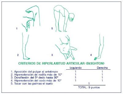 El Síndrome de Hipermovilidad Articular (SHA) · Diagnóstico El Síndrome de Hipermovilidad Articular (SHA) · Diagnóstico
