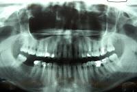 El Síndrome de Hipermovilidad Articular (SHA) · Síntomas El Síndrome de Hipermovilidad Articular (SHA) · Síntomas