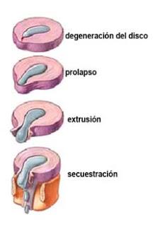 ¿Qué es una extrusión de disco en una Hernia Discal? ¿Qué es una extrusión de disco en una Hernia Discal?