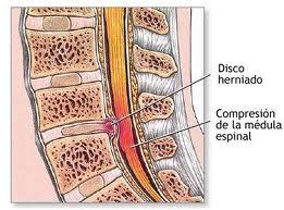 ¿Sirve la Quiropráctica para curar una hernia de disco?