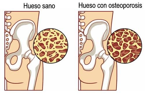 ¿Cómo prevenir la osteoporosis?